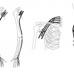 Nervus radialis, Nervus Ulnaris, Plexus brachialis and Nervus fibularis