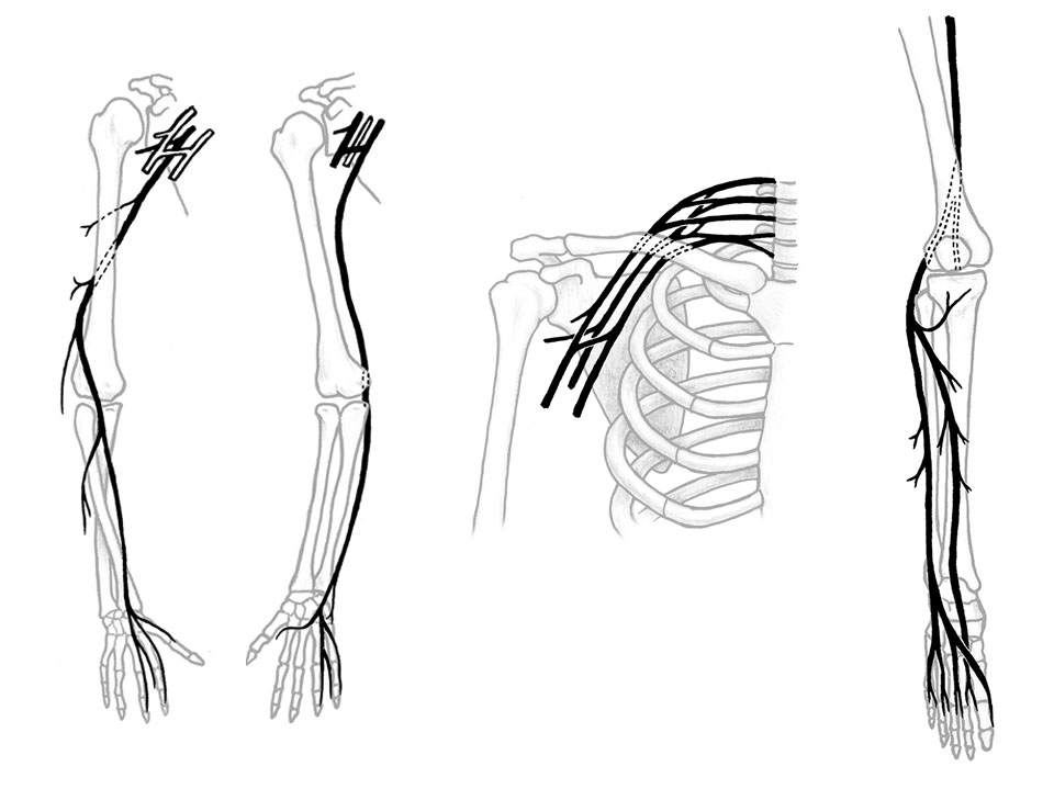 Nervus radialis, Nervus Ulnaris, Plexus brachialis and Nervus fibularis